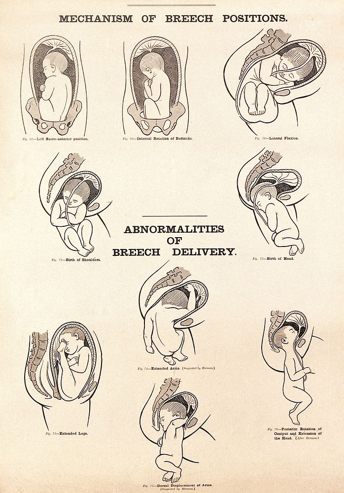 Mechanism breech positions and abnormalities | Free Photo Illustration ...