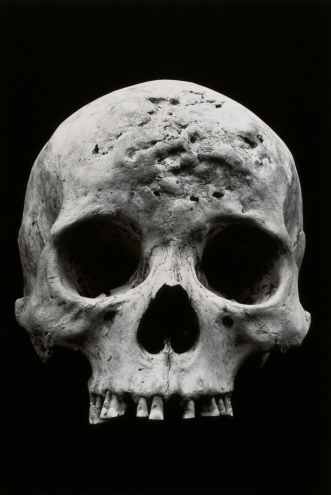 An Alaskan Inuit skull, showing the effects of syphilis. Photograph by Ales Hrdlicka, ca. 1910.