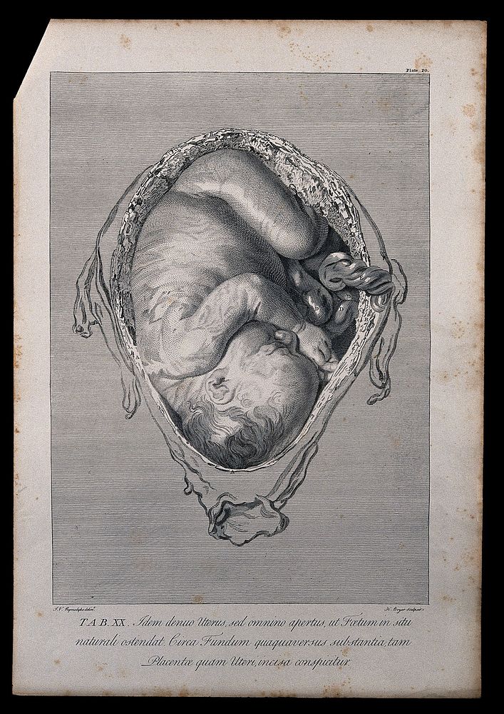 Dissection of the pregnant uterus, showing the foetus at eight months, with the head positioned towards the vagina.…