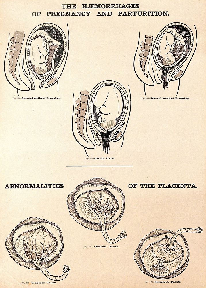 Haemorrhages of pregnancy and parturition, and abnormalities of the placenta. Lithograph after W. F. Victor Bonney.
