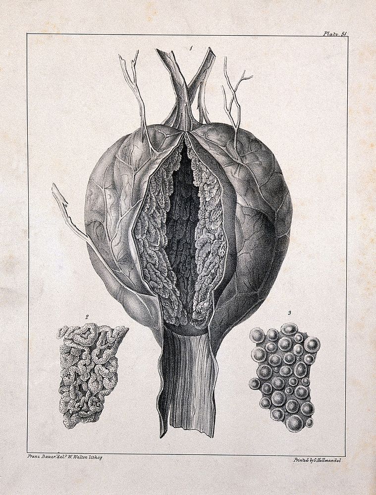 A diseased part of the body. Lithograph by W. Walton after Franz Bauer.