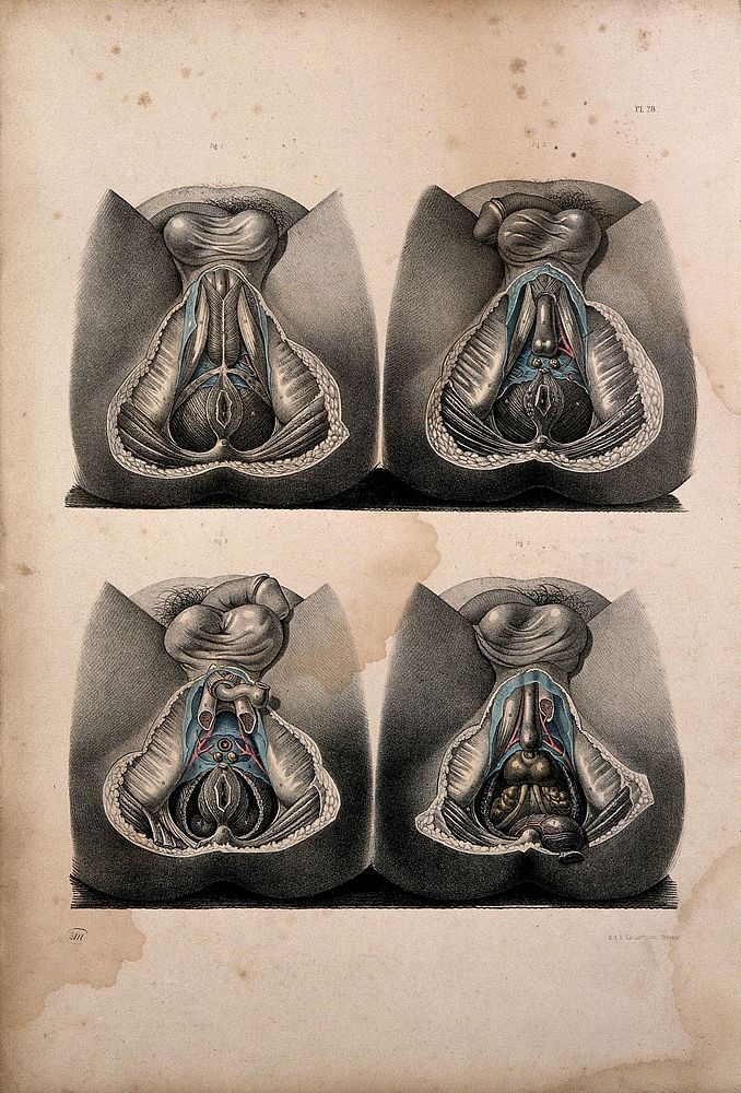 Dissection of the perinaeum of a man: four figures. Coloured lithograph by J. Maclise, 1851.