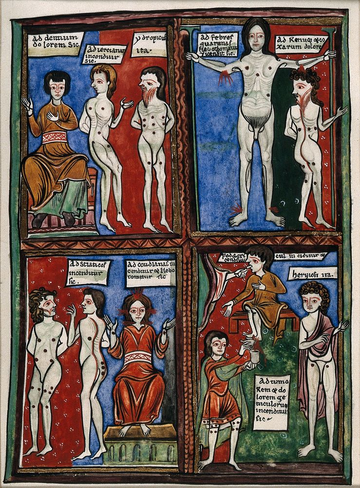 Four vignettes demonstrating different cauterisation points on naked human bodies. Watercolour after a twelfth century…