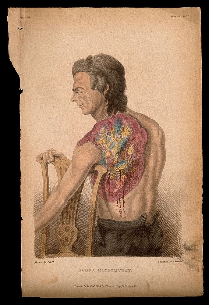 James M'Gillivray, a man shot in the shoulder in the siege of Nijmegen (1794): the shot developed into an ulcer which was…