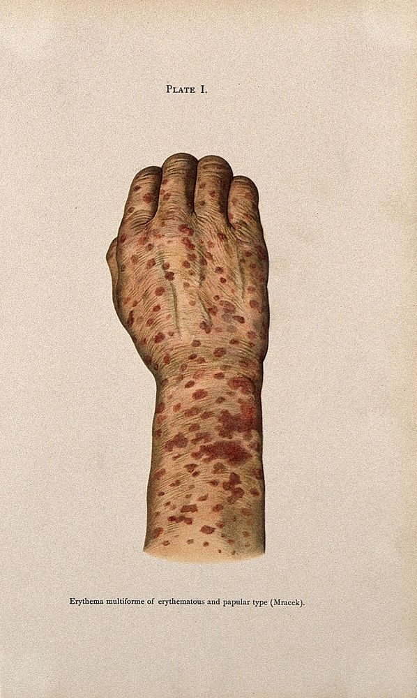 A hand and wrist covered in a rash of sores, showing symptoms of erythema. Colour lithograph after Mracek , ca. 1905.