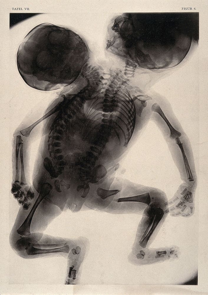 A skeleton of a child born with two backbones and two heads. Collotype by Römmler & Jonas after a radiograph made for G.…