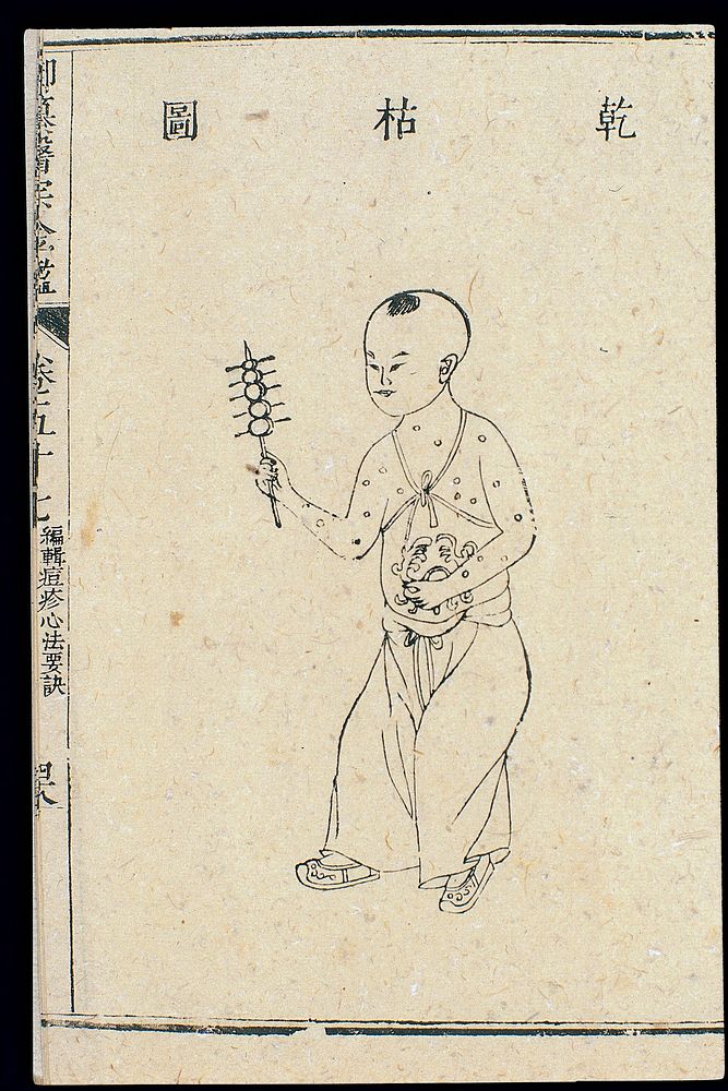 Chinese C18: Paediatric pox - 'Dry and Wizened' pox