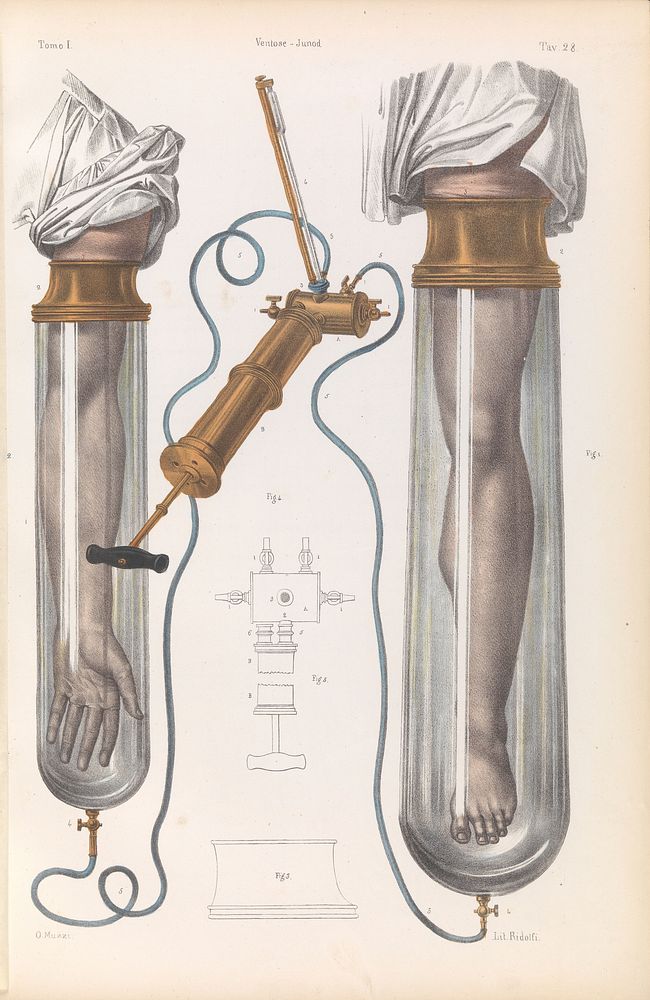 Plate 28. Cupping devices for the arm and leg.