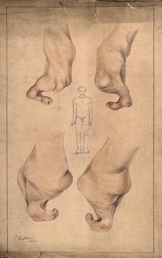 The deformed hands and feet of a young man suffering from congenital malformation: shown beside a sketch of the man himself.…