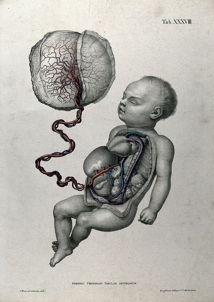 A baby, with thorax and abdomen dissected, attached by umbilical cord to the placenta, with the arteries, blood vessels and…