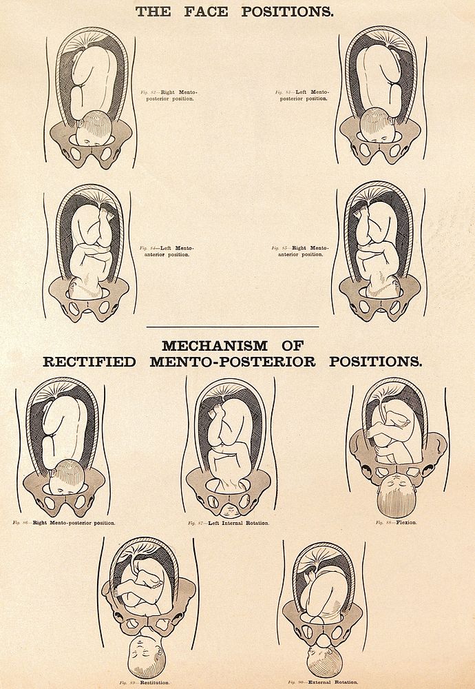The face positions and the mechanism of rectified mento-posterior positions in childbirth. Lithograph after W. F. Victor…