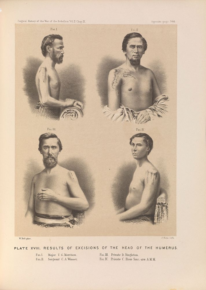Plate XVIII. Results of excisions of the head of the humerus. American Civil War (1861-65).