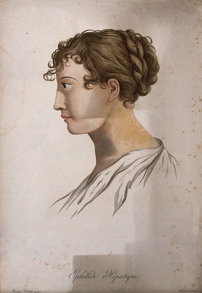 Head of a woman with a skin disease on her neck. Coloured stipple engraving by S. Tresca after Moreau-Valvile, c. 1806.