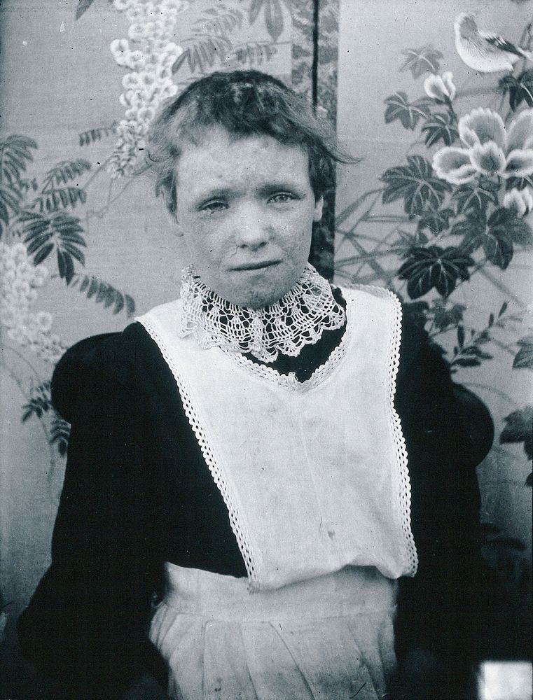 Gloucester smallpox epidemic, 1896: Kate Mills, a smallpox patient. Photograph by H.C.F., 1896.