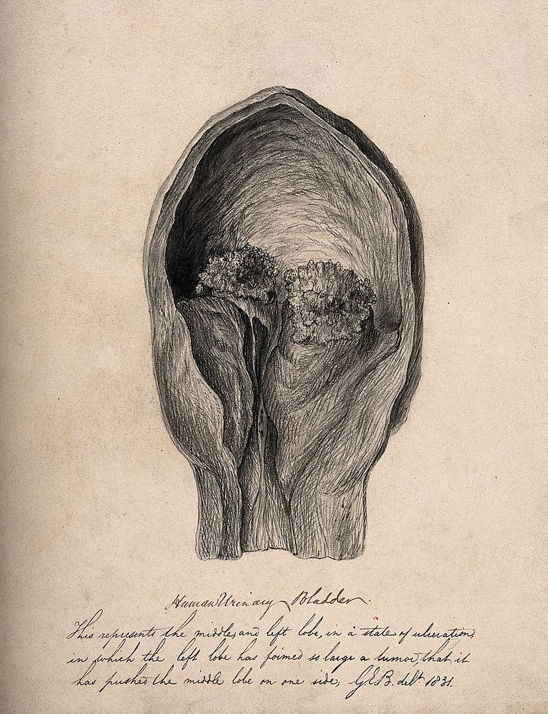 A human bladder with a tumour. Pencil drawing by G.E. Blenkins, 1831.