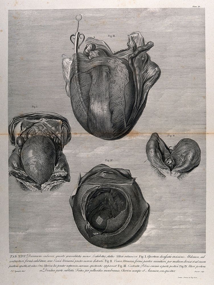 Dissections of a retroverted pregnant uterus, shown with the bladder, at five months: two figures. Copperplate engraving by…