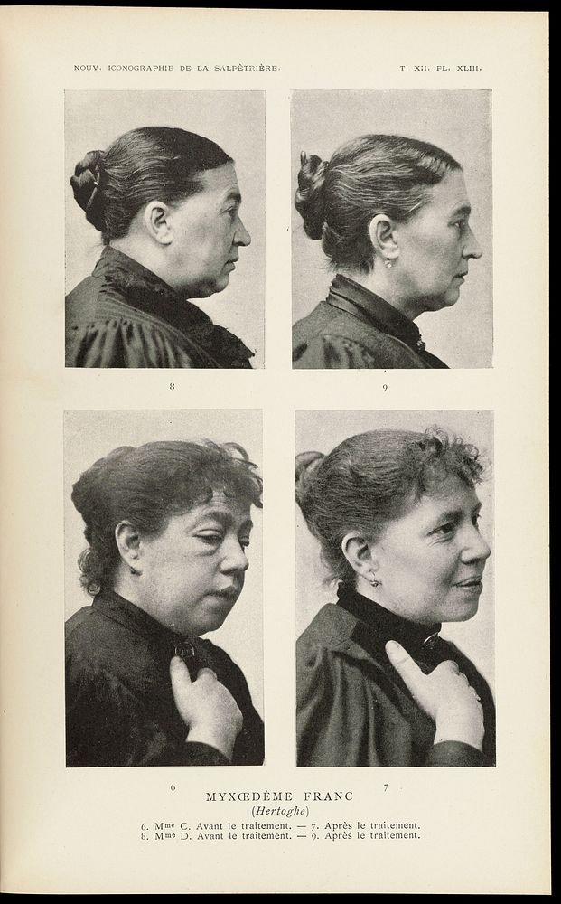Photographs showing females with myxedema