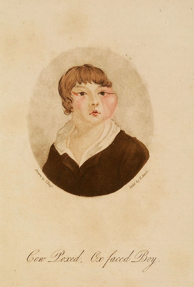 Cow Poxed, Ox Faced Boy - illustration to "Cow-Pox Inoculation No Security Against Small-Pox Infection" by W. Rowley.