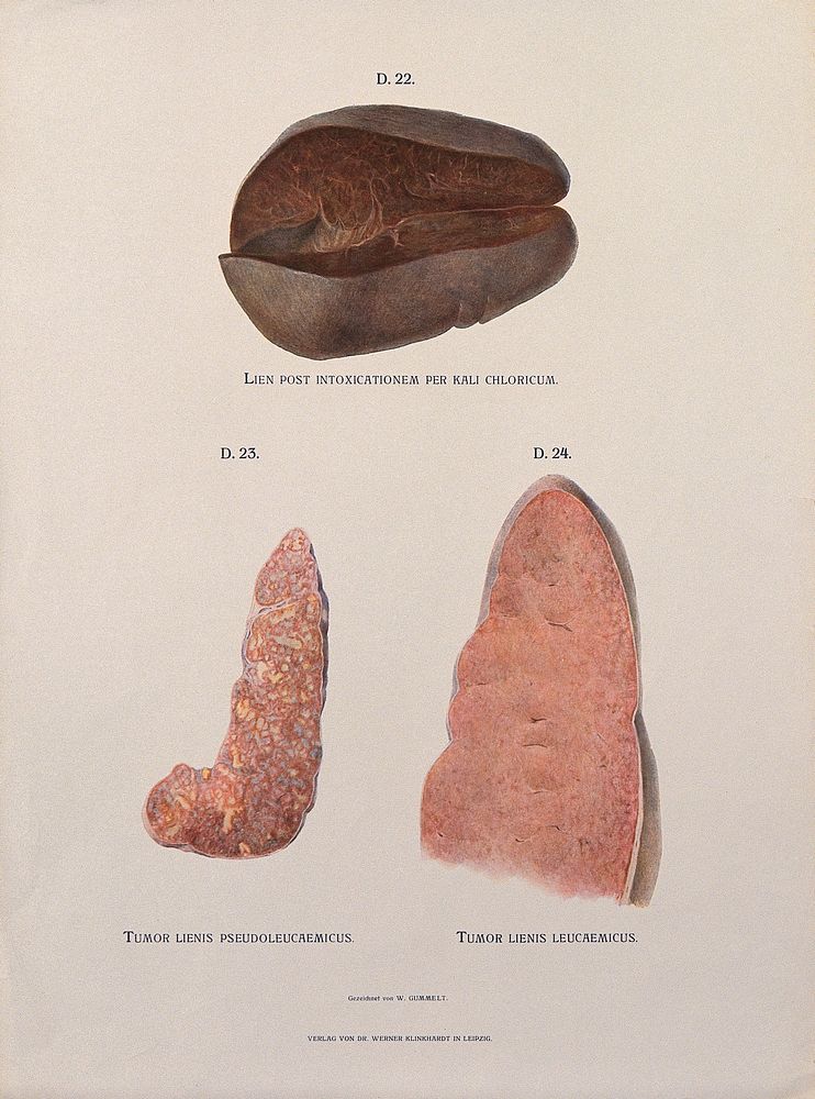 Dissections of diseased spleen: three figures. Chromolithograph by W. Gummelt, ca. 1897.