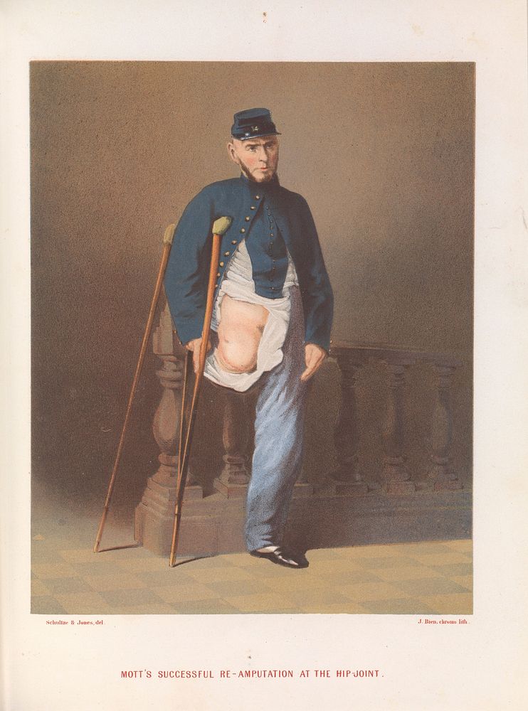 A report on amputations at the hip-joint in military surgery / by George A. Otis.