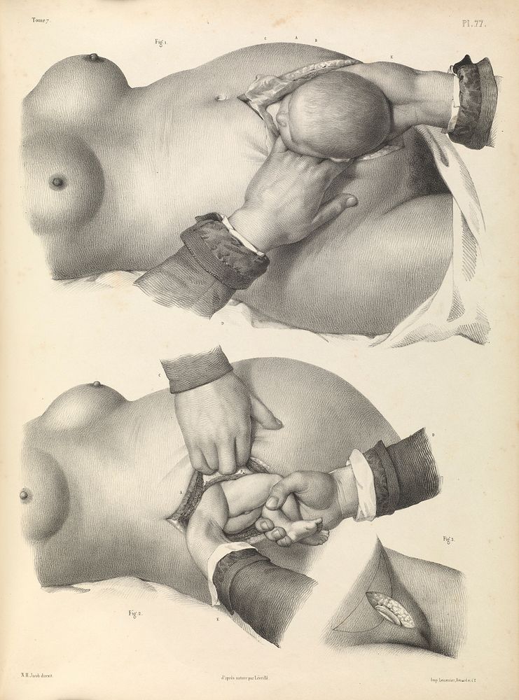 Traité complet de l'anatomie de l'homme comprenant la médecine opératoire ... : avec planches lithographiées ... / par N.H.…
