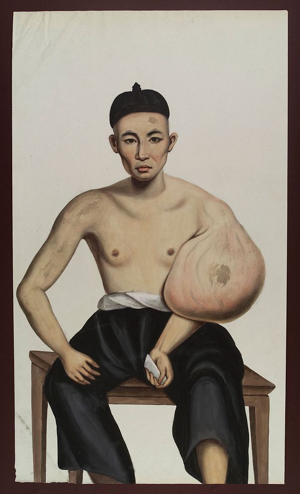 A man (Po Ashing) with a tumour on his left arm. Gouache, 18--, after Lam Qua, 1836.