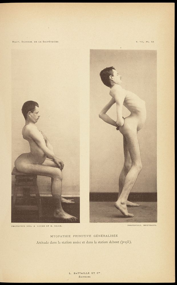 Two photographs showing primitive myopathy. Caption: 'Myopathie Primitive Generalisee'