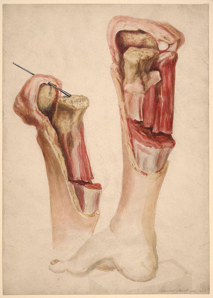 Foot and leg of a boy who had acute inflammation of the upper epiphysis of the tibia