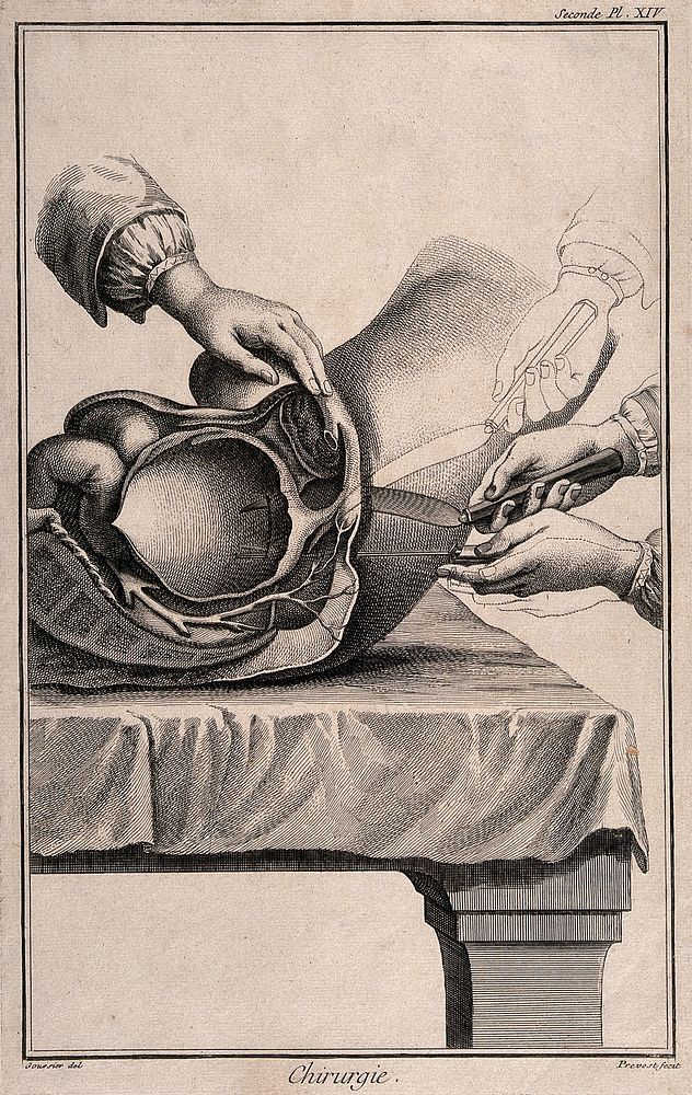 A lateral incision into the hypogastrium for removal of bladder stone. Engraving by B. Prevost after L.J. Goussier.