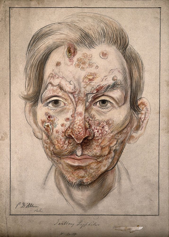 Head of a man with a syphilitic lesions affecting his face. Watercolour by Christopher D' Alton, 1874.