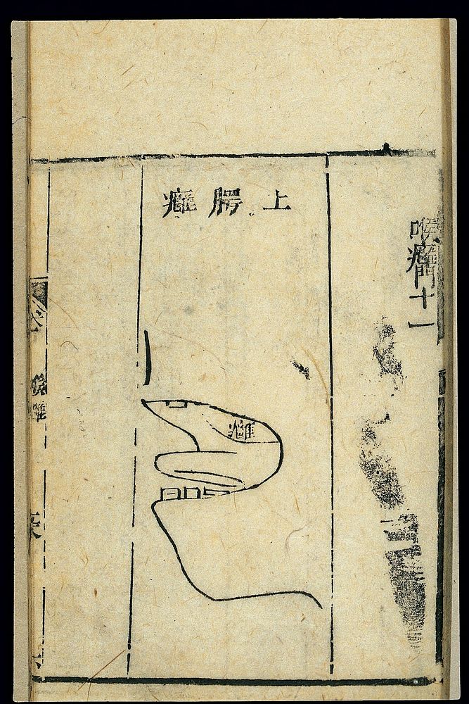 Chinese C19 woodcut: Abscesses on the palate
