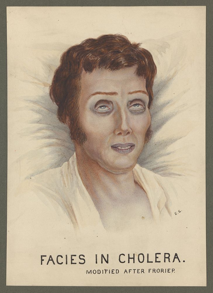 A cholera victim with a typical facial appearance. Watercolour by E. Schwarz, 1920/1950 , after Robert Froriep, ca. 1831.