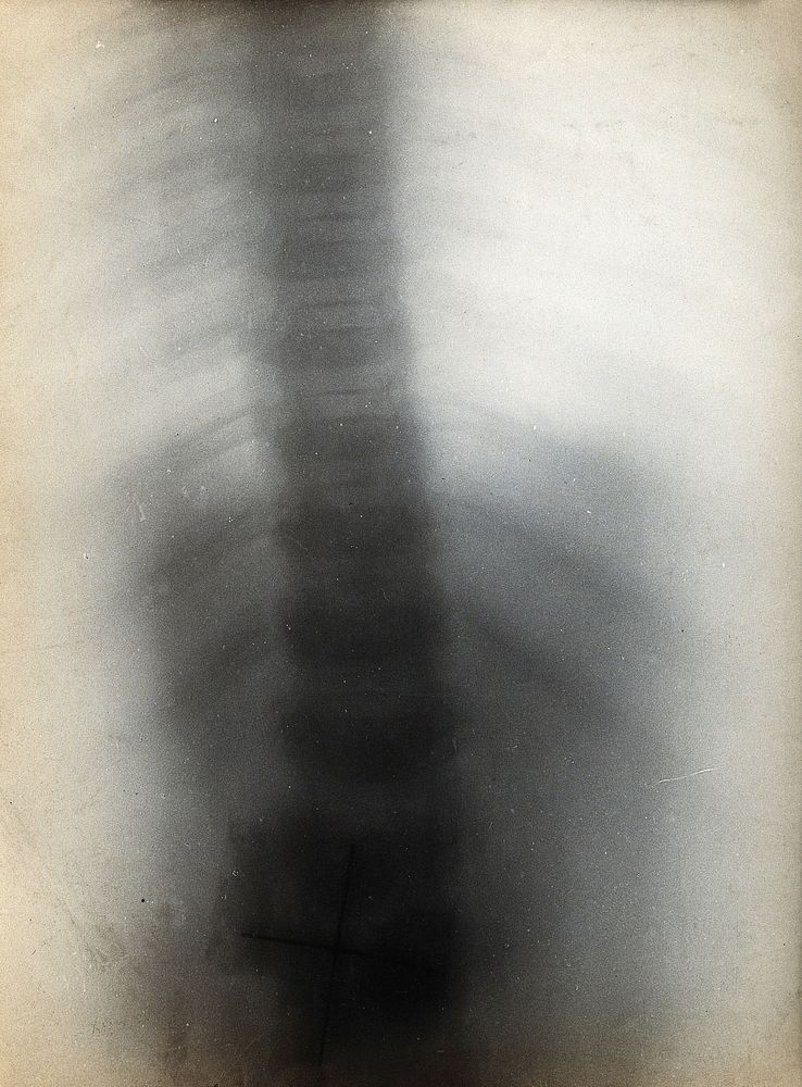 The bones of the ribs and vertebral column, viewed through x-ray. Photoprint from radiograph after Sir Arthur Schuster, 1896.