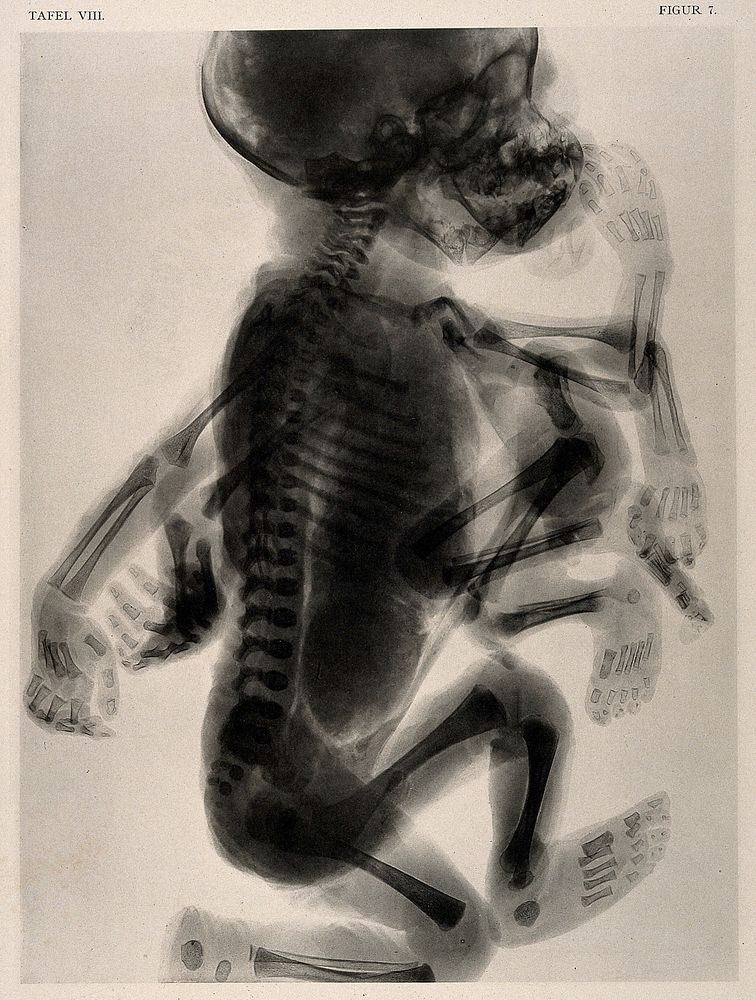 A skeleton of a child with a set of superfluous limbs and deformed head. Collotype by Römmler & Jonas after a radiograph…