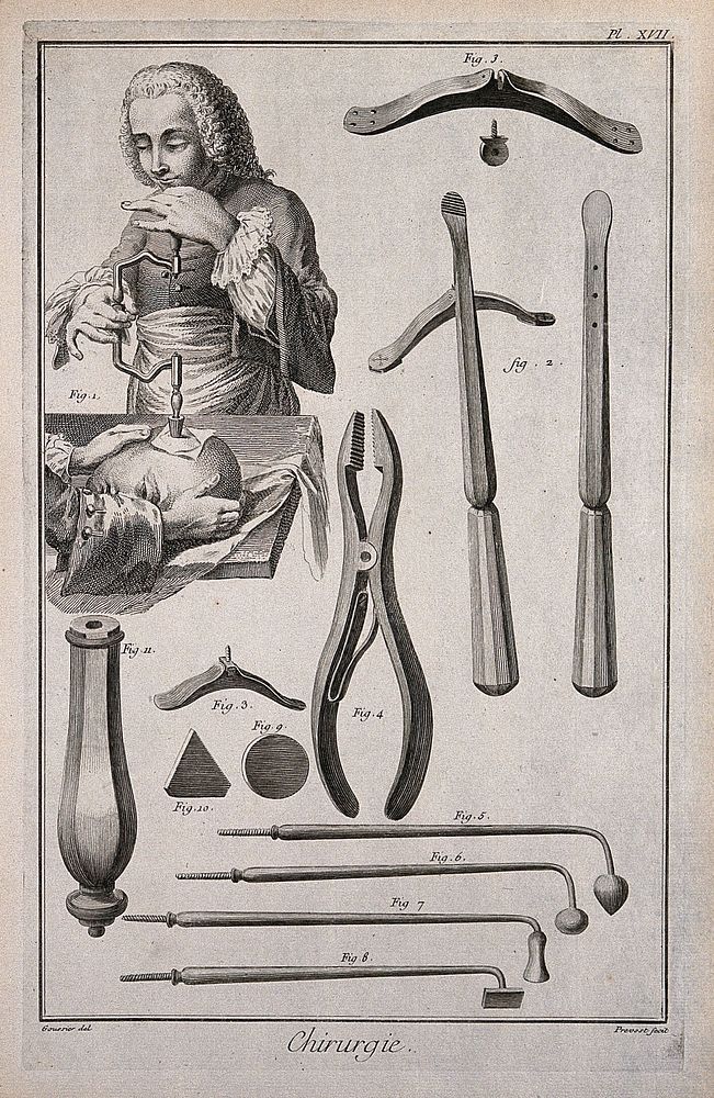 Surgery: above, a skull being trepanned; below, various instruments used in trepanation. Engraving with etching by B.L.…