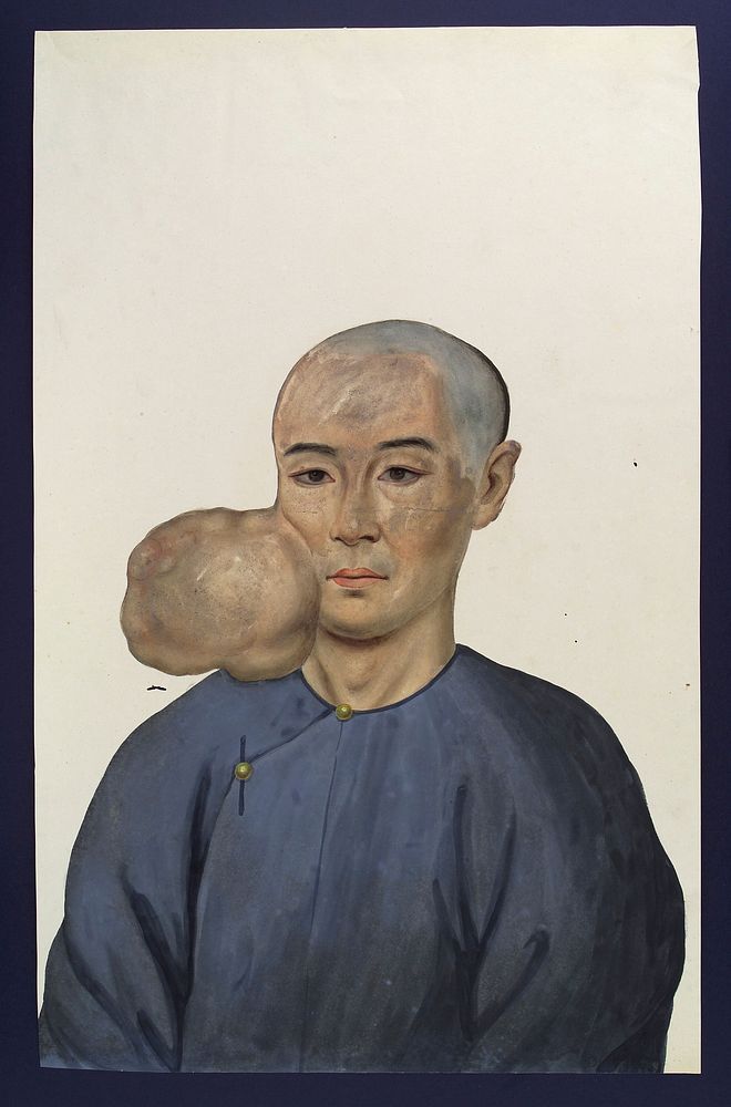 A man (Chang Achum), facing front, with a tumour on the right side of his face. Gouache, 18--, after Lam Qua, 1837.