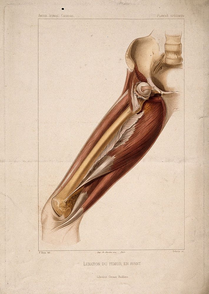 A dislocated femur bone: dissection of the thigh, showing the bone and surrounding muscles. Coloured stipple engraving by…