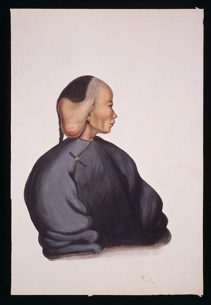 A woman with a pendent tumour over her right ear. Gouache, 18--, after Lam Qua, ca. 183-.