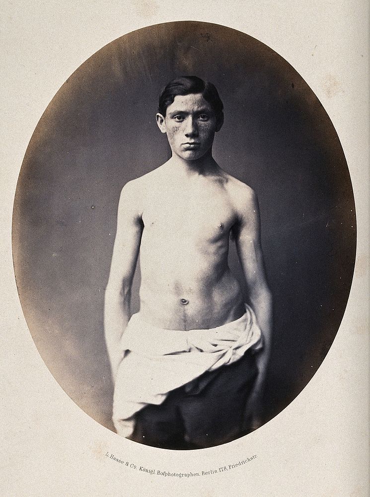 A standing young man, 3/4 length view, partially clothed; showing a deformity of the left hip. Photograph by L. Haase after…