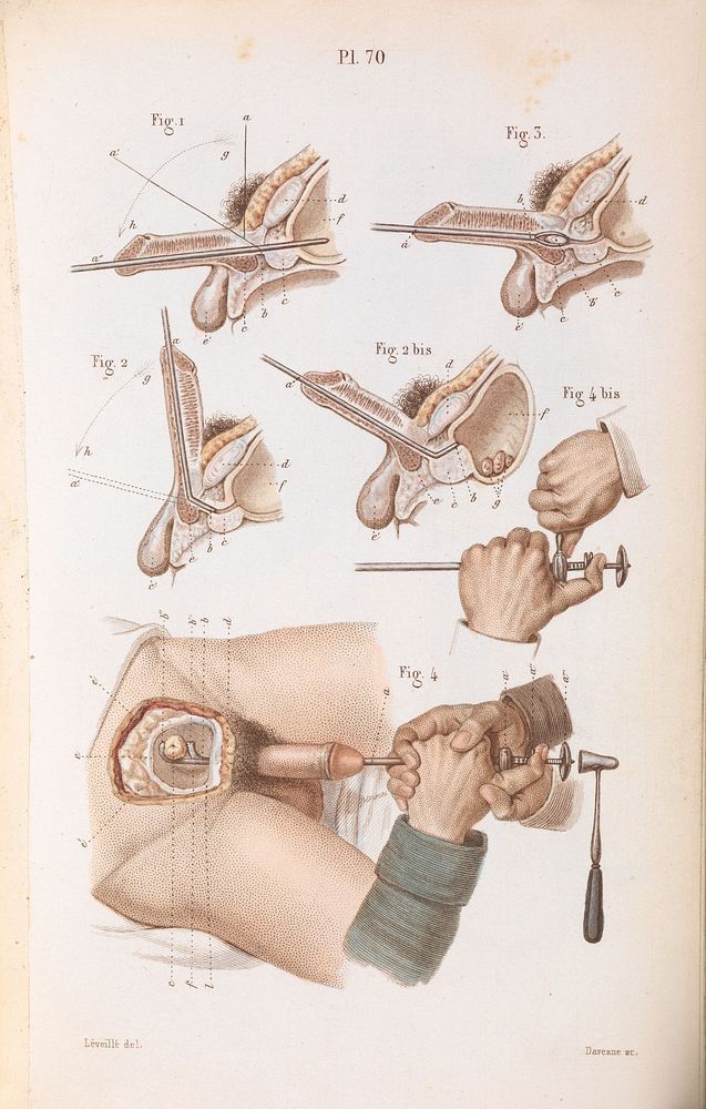 Plate 70, Surgical technique for lithotripsy