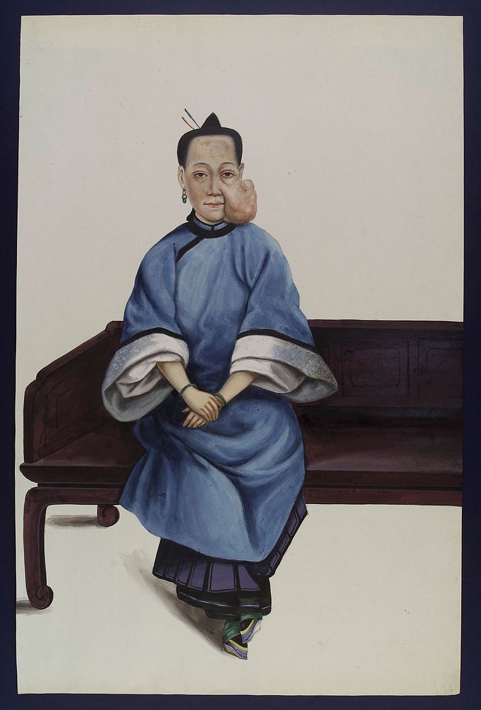 A woman (Lo Wanshun) with a tumour on her left cheek. Gouache, 18--, after Lam Qua, 1836.