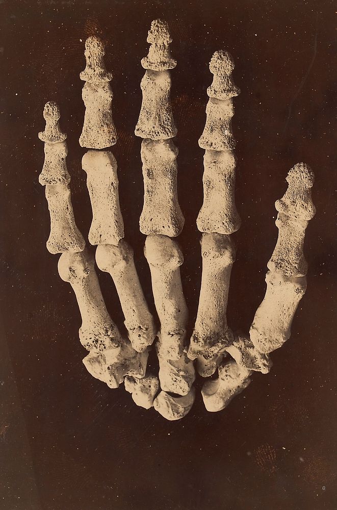 Bones of right hand illustrating the appearances associated with pulmonary osteo-arthropathy