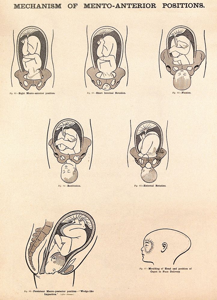 Mechanism of mento-anterior positions in childbirth. Lithograph after W. F. Victor Bonney.