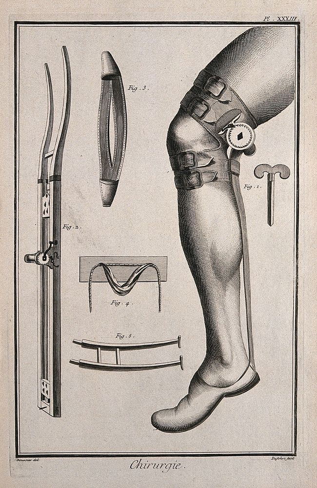 Surgery: surgical instruments for the correction of dislocated limbs. Engraving with etching by A.J. Defehrt after L.-J.…