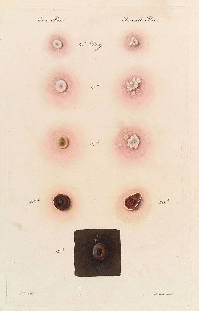 Close up of stages of cow-pox and smallpox