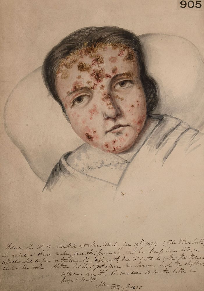 Eruption of the face of a young woman who worked making seal skin purses