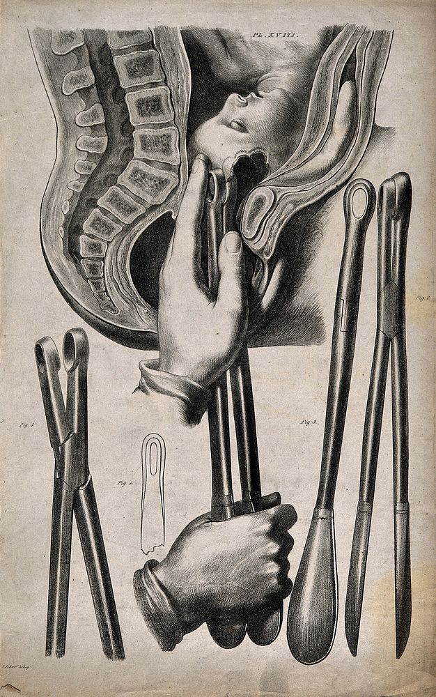 A diagram demonstrating different kinds of forceps, and their use in childbirth. Lithograph by G. Scharf.
