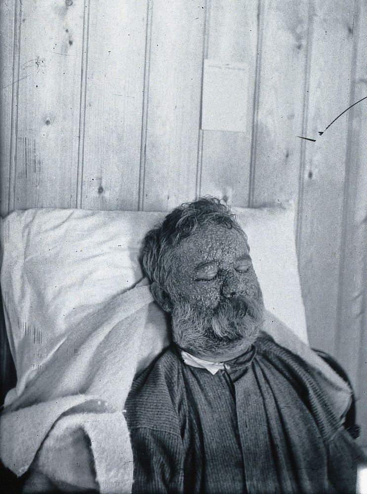 Gloucester smallpox epidemic, 1896: George Steel, a smallpox patient. Photograph by H.C.F., 1896.