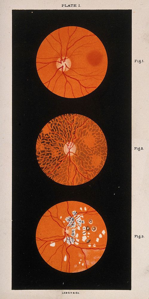 The eye, as seen through a microscope: three figures. Colour lithograph, ca. 1861.