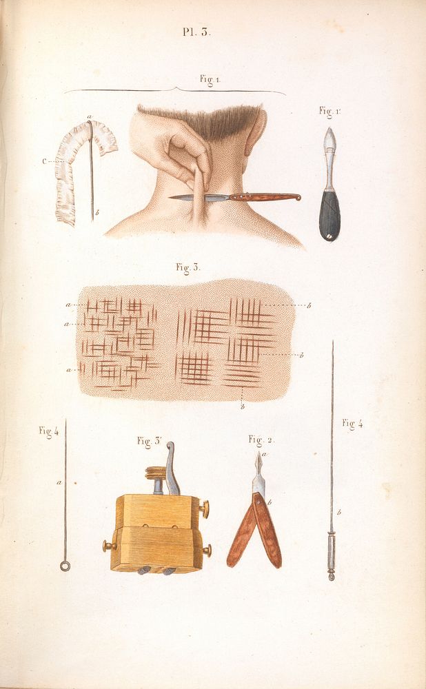Plate 3, Illustration of a seton stitch.